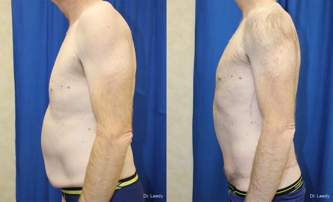 Circumferential Body Lift: Patient 2 - Before and After 5