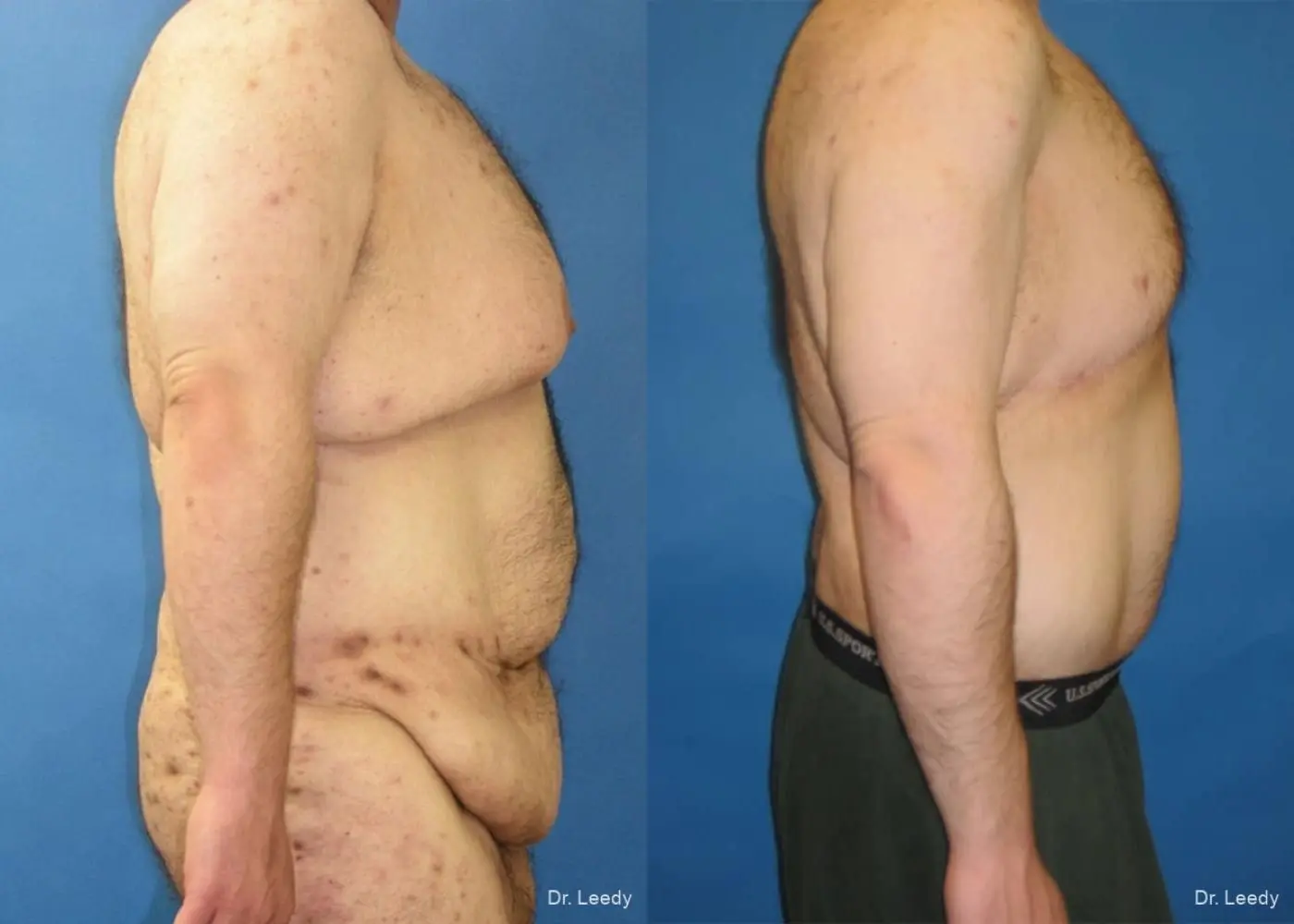 Circumferential Body Lift: Patient 4 - Before and After 3