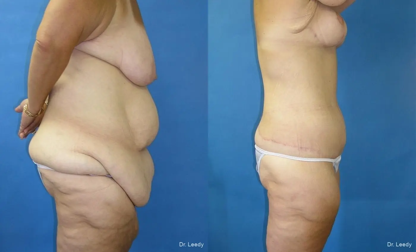 Circumferential Body Lift: Patient 1 - Before and After 3
