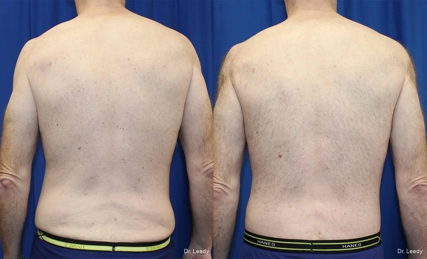 Circumferential Body Lift: Patient 2 - Before and After 6