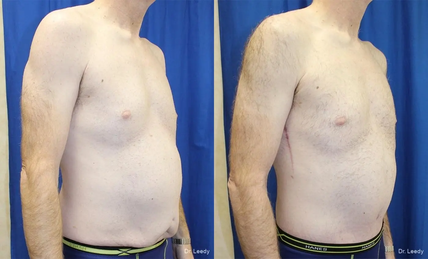Circumferential Body Lift: Patient 2 - Before and After 2