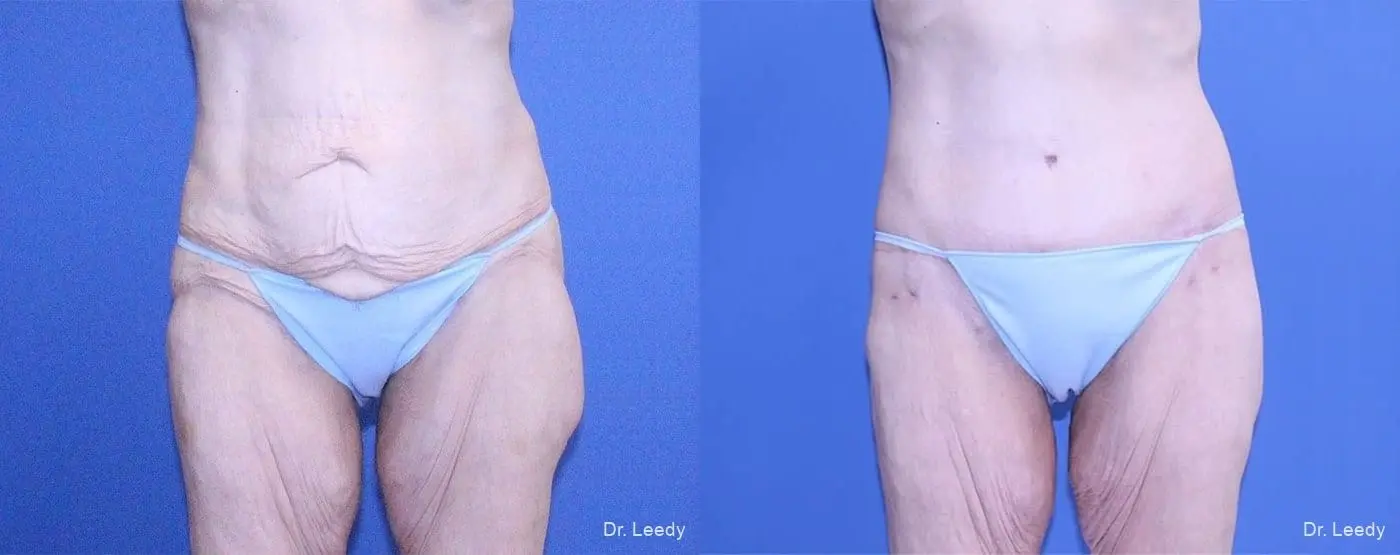 Circumferential Body Lift: Patient 3 - Before and After 1