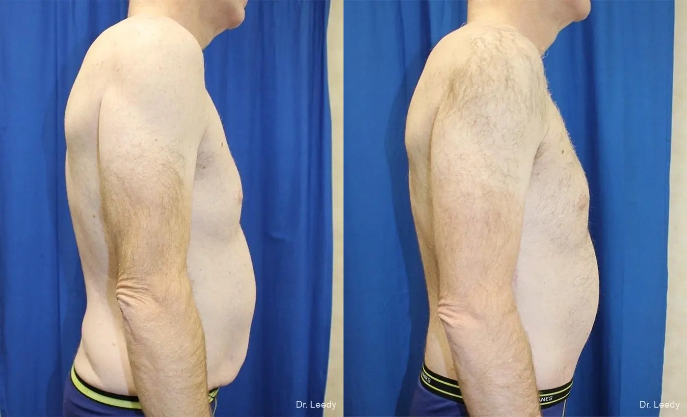 Circumferential Body Lift: Patient 2 - Before and After 3