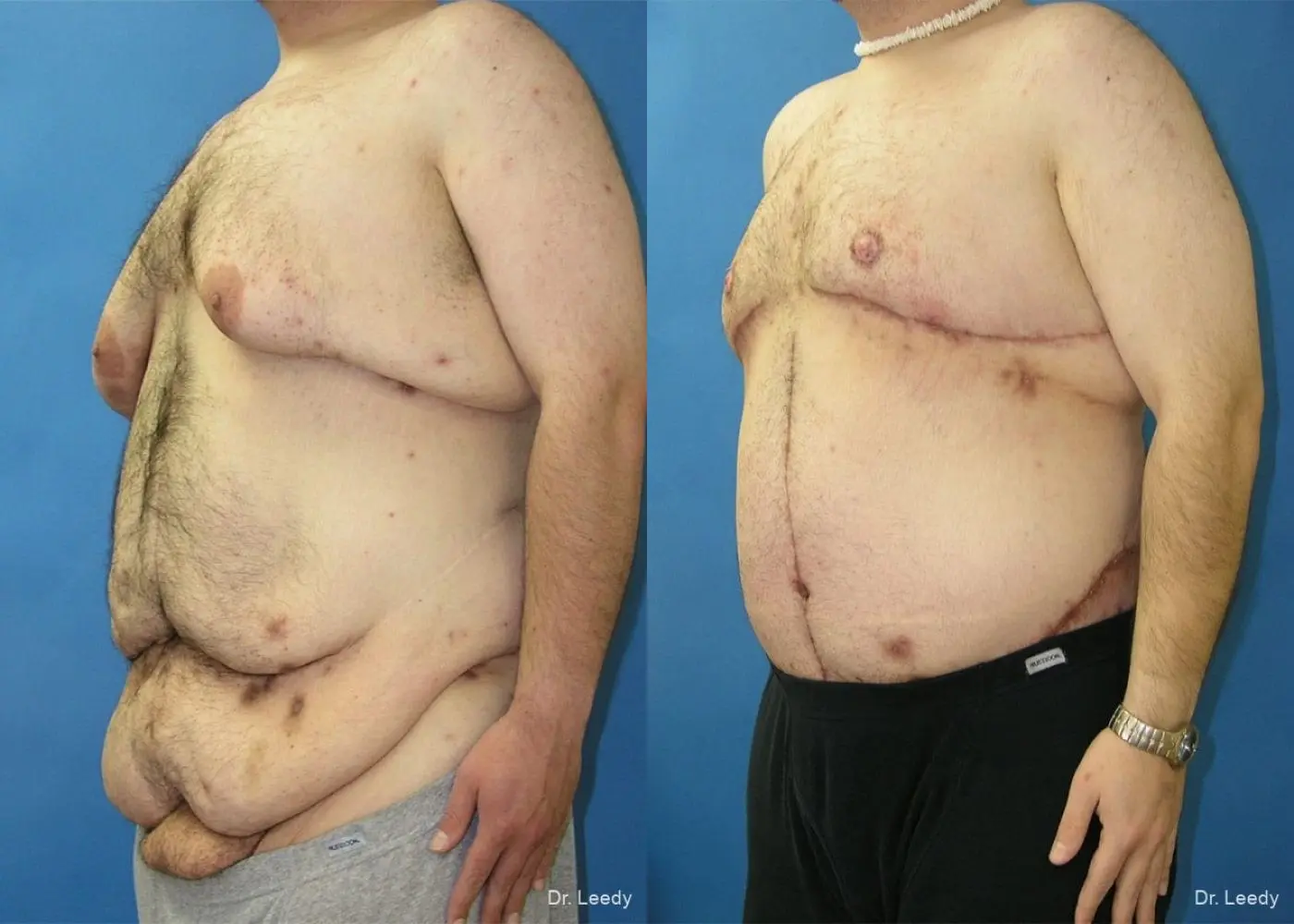 Circumferential Body Lift: Patient 4 - Before and After 4