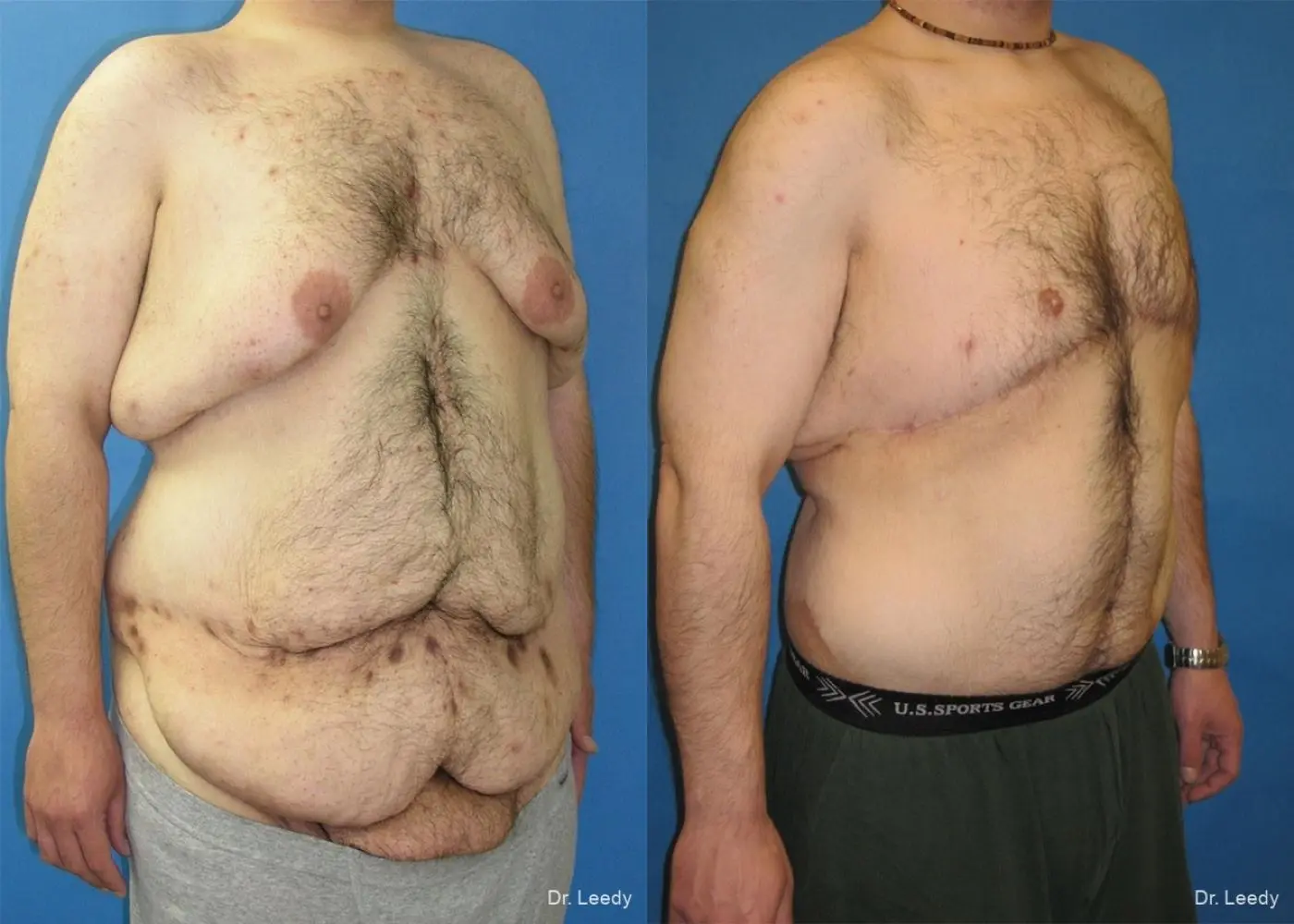 Circumferential Body Lift: Patient 4 - Before and After 2