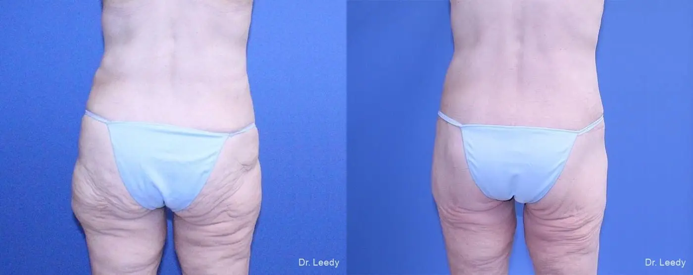 Circumferential Body Lift: Patient 3 - Before and After 3