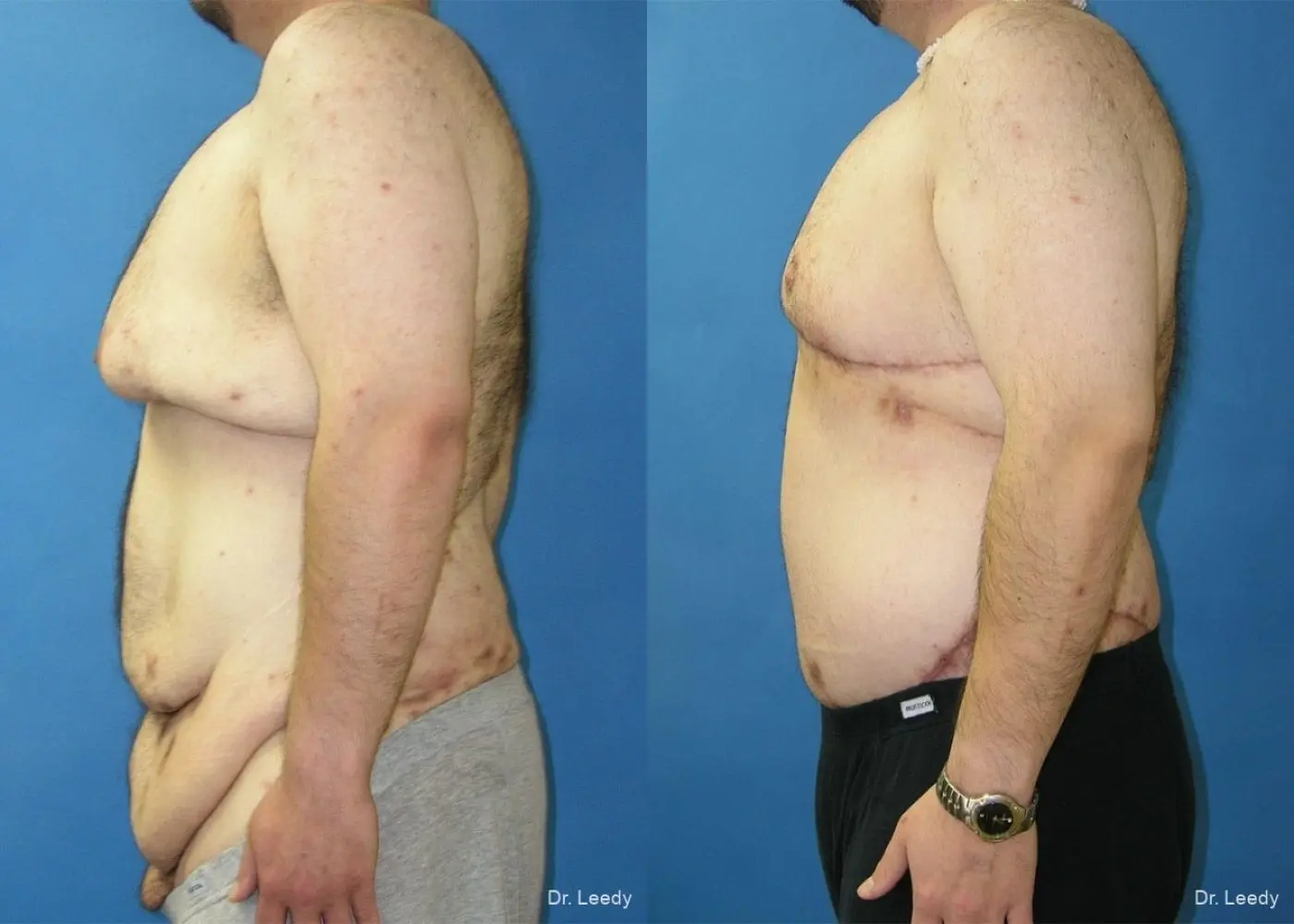 Circumferential Body Lift: Patient 4 - Before and After 5