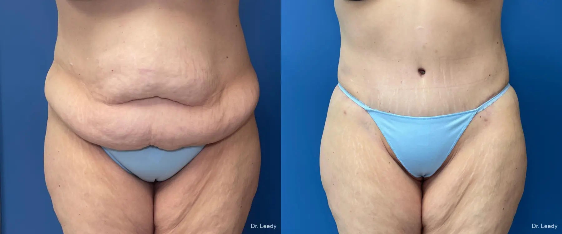 Circumferential Body Lift: Patient 5 - Before and After  