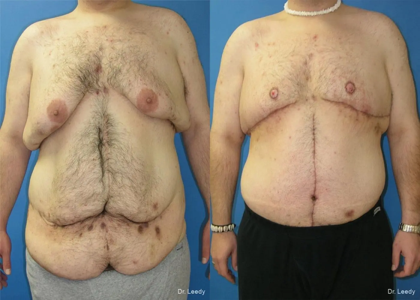 Circumferential Body Lift: Patient 4 - Before and After  