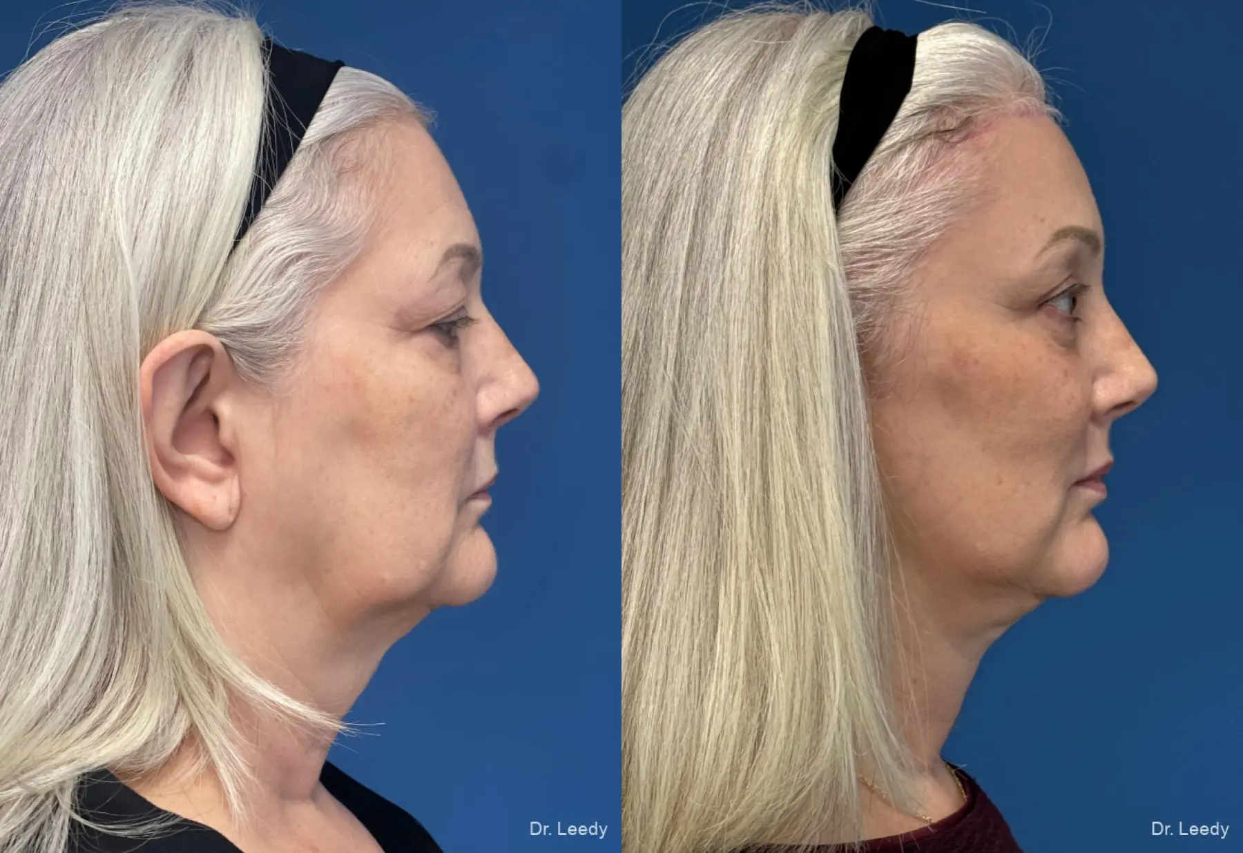 Facelift & Neck Lift: Patient 10 - Before and After  