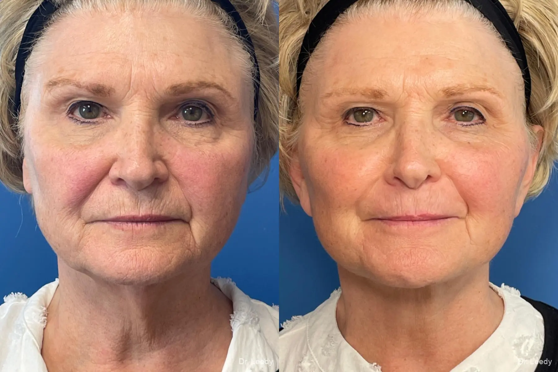 Facelift & Neck Lift: Patient 7 - Before and After 4