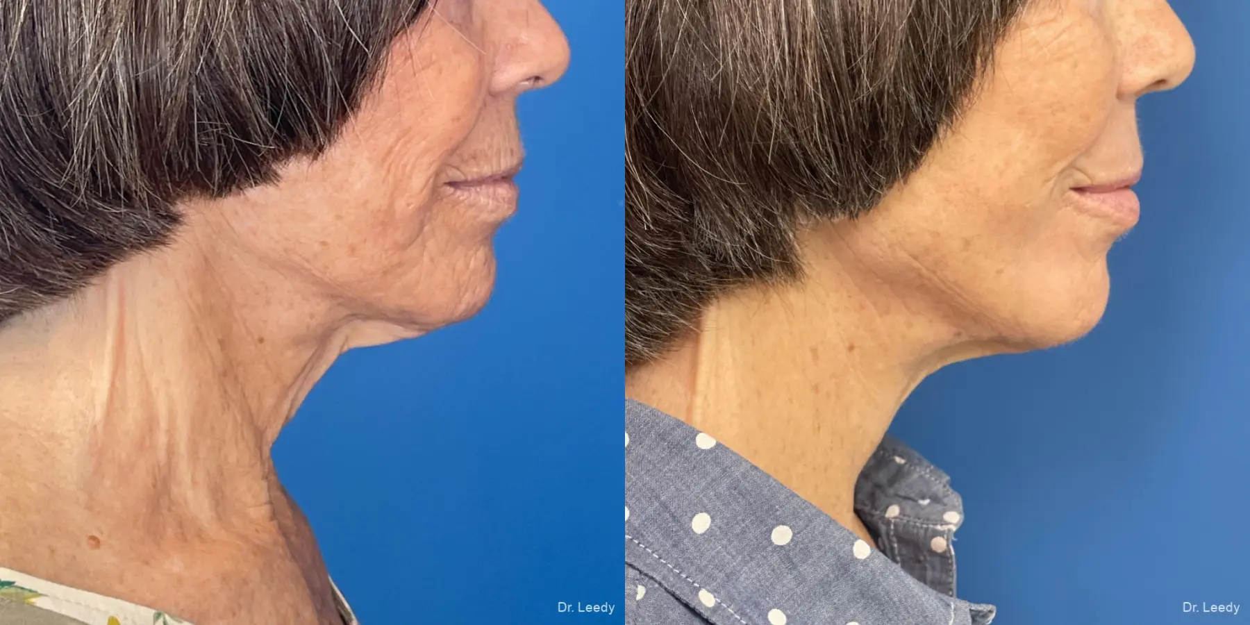 Facelift & Neck Lift: Patient 6 - Before and After 3