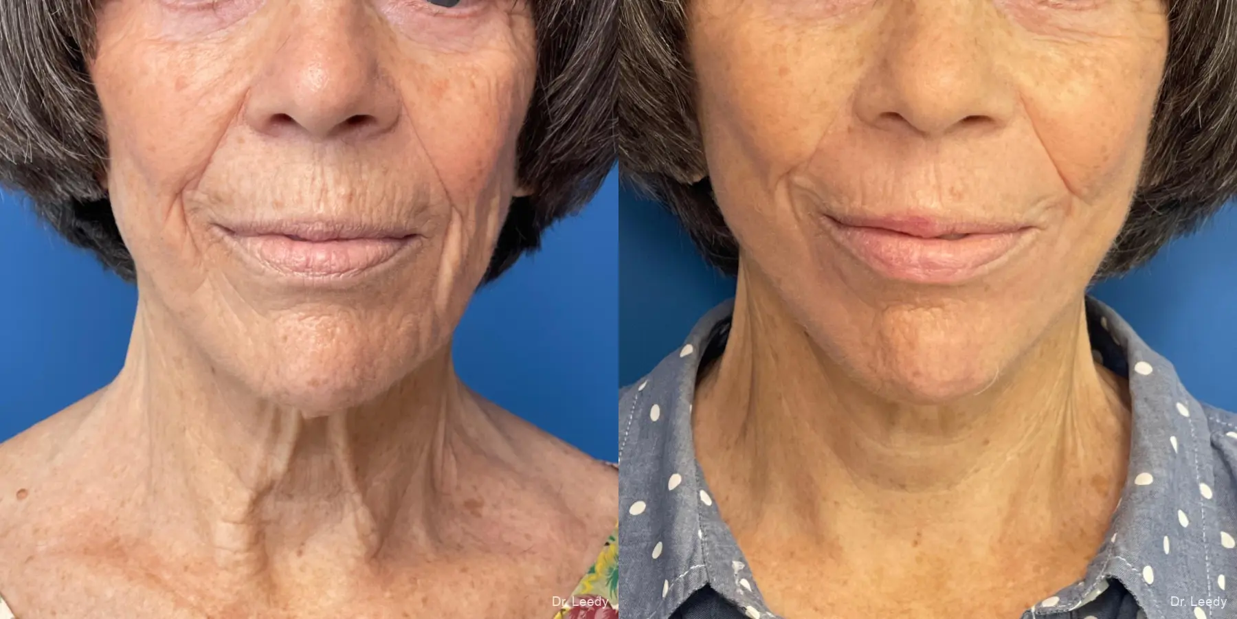 Facelift & Neck Lift: Patient 6 - Before and After  