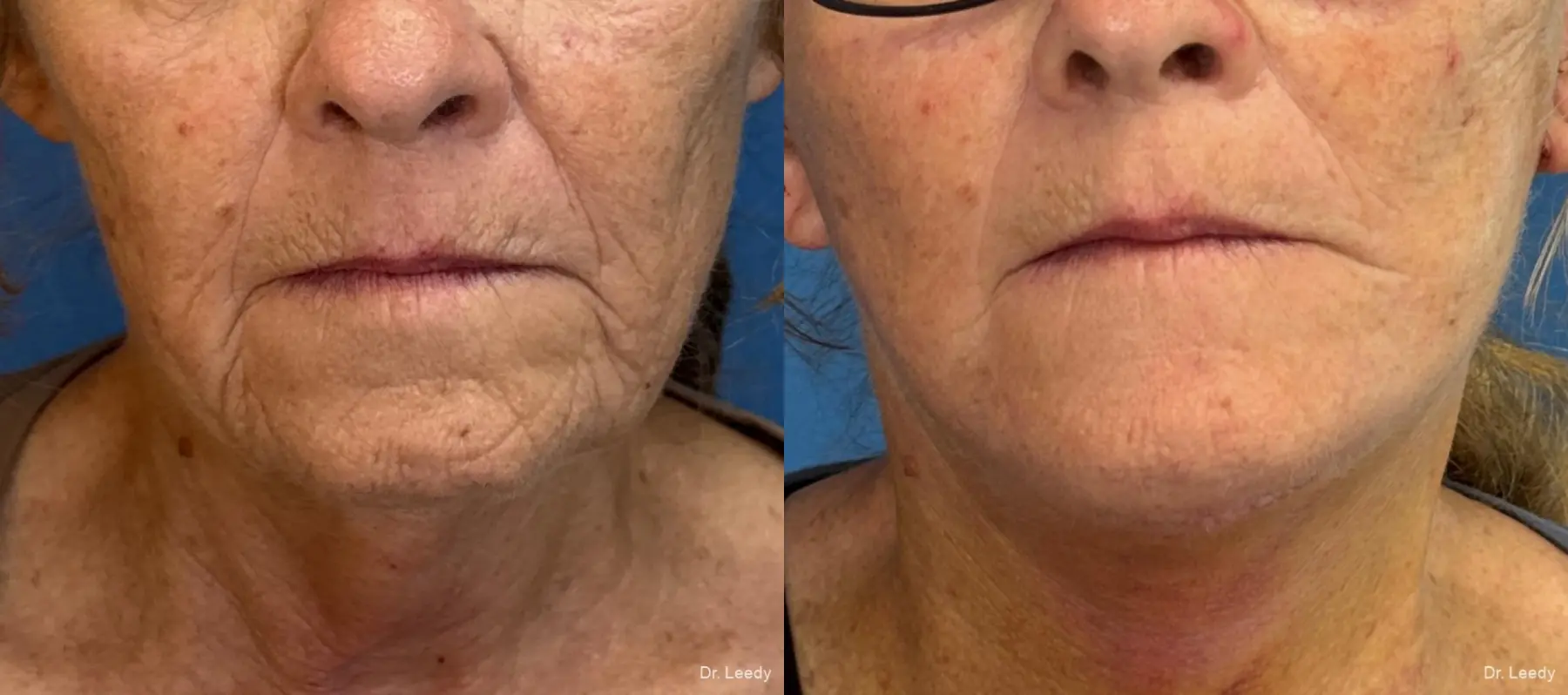 Facelift & Neck Lift: Patient 12 - Before and After  