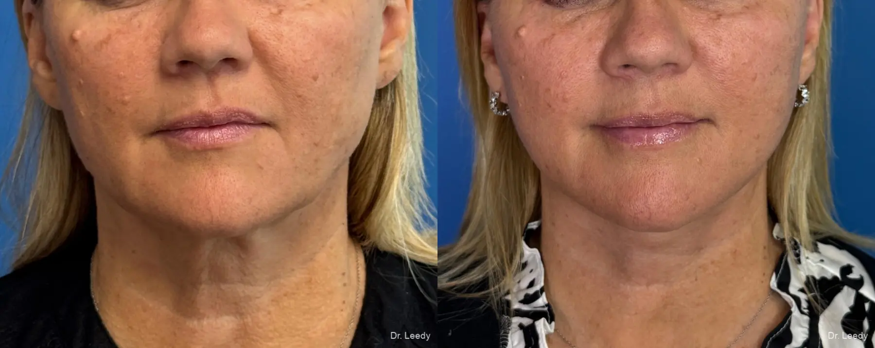 Facelift & Neck Lift: Patient 15 - Before and After  