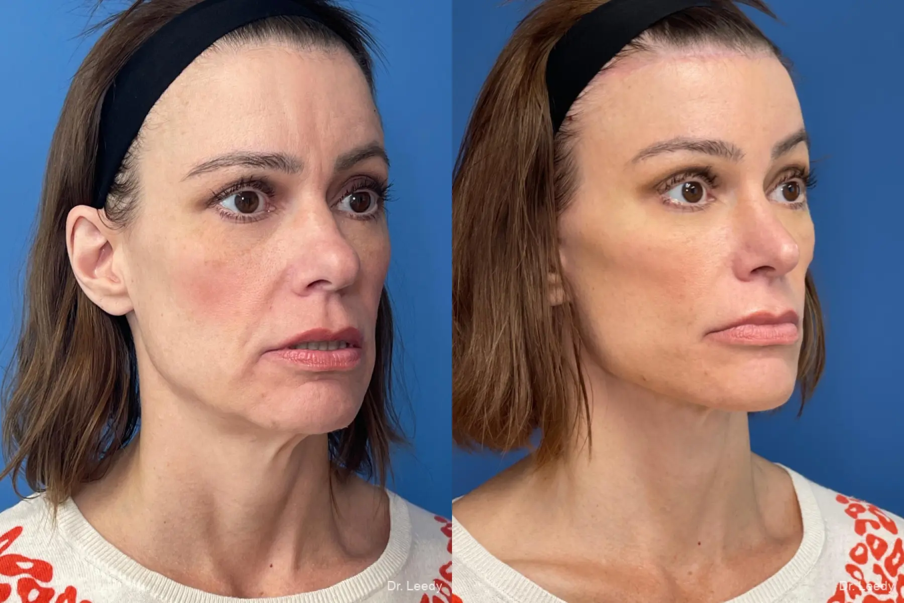 Facelift & Neck Lift: Patient 1 - Before and After  