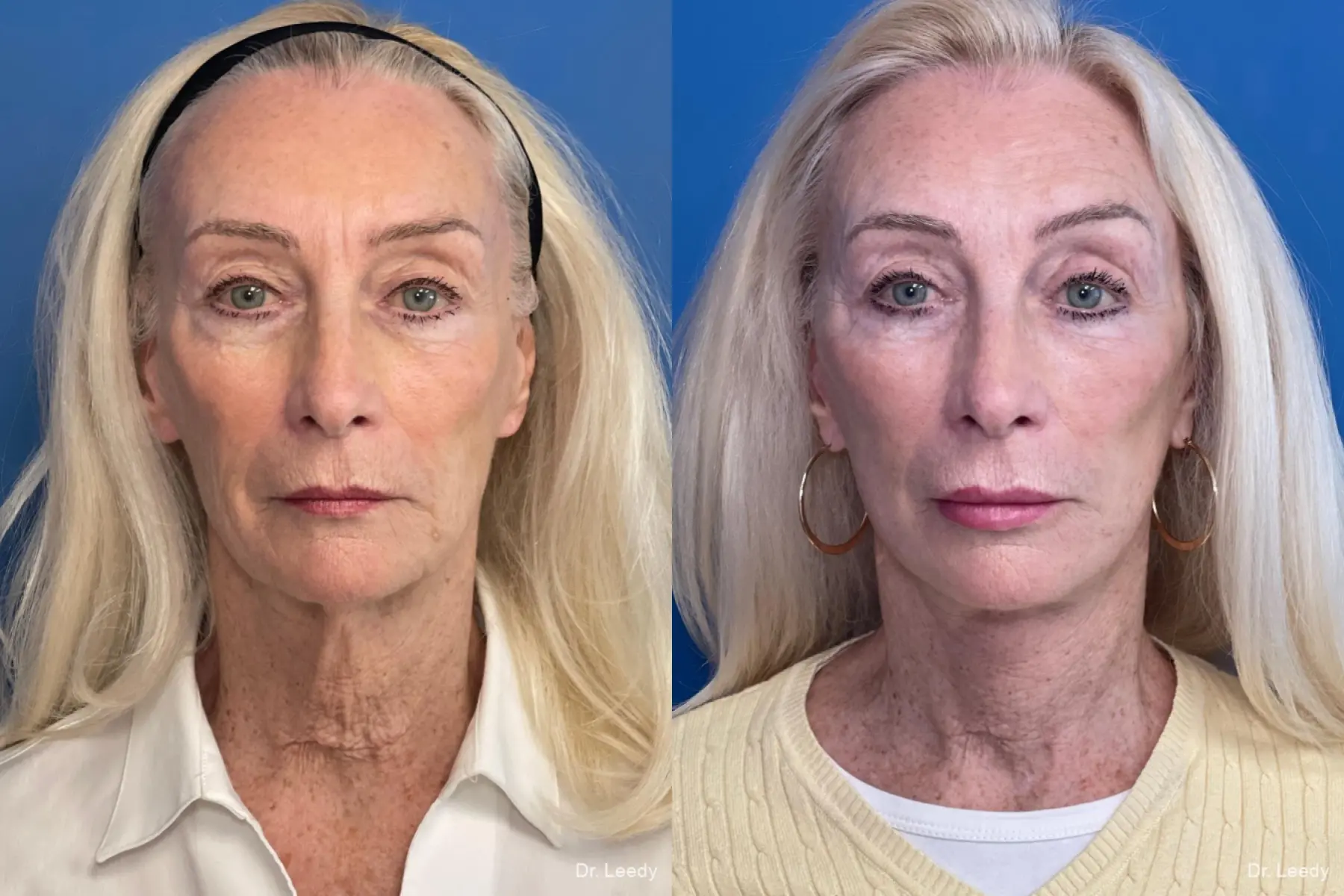 Facelift & Neck Lift: Patient 4 - Before and After 1