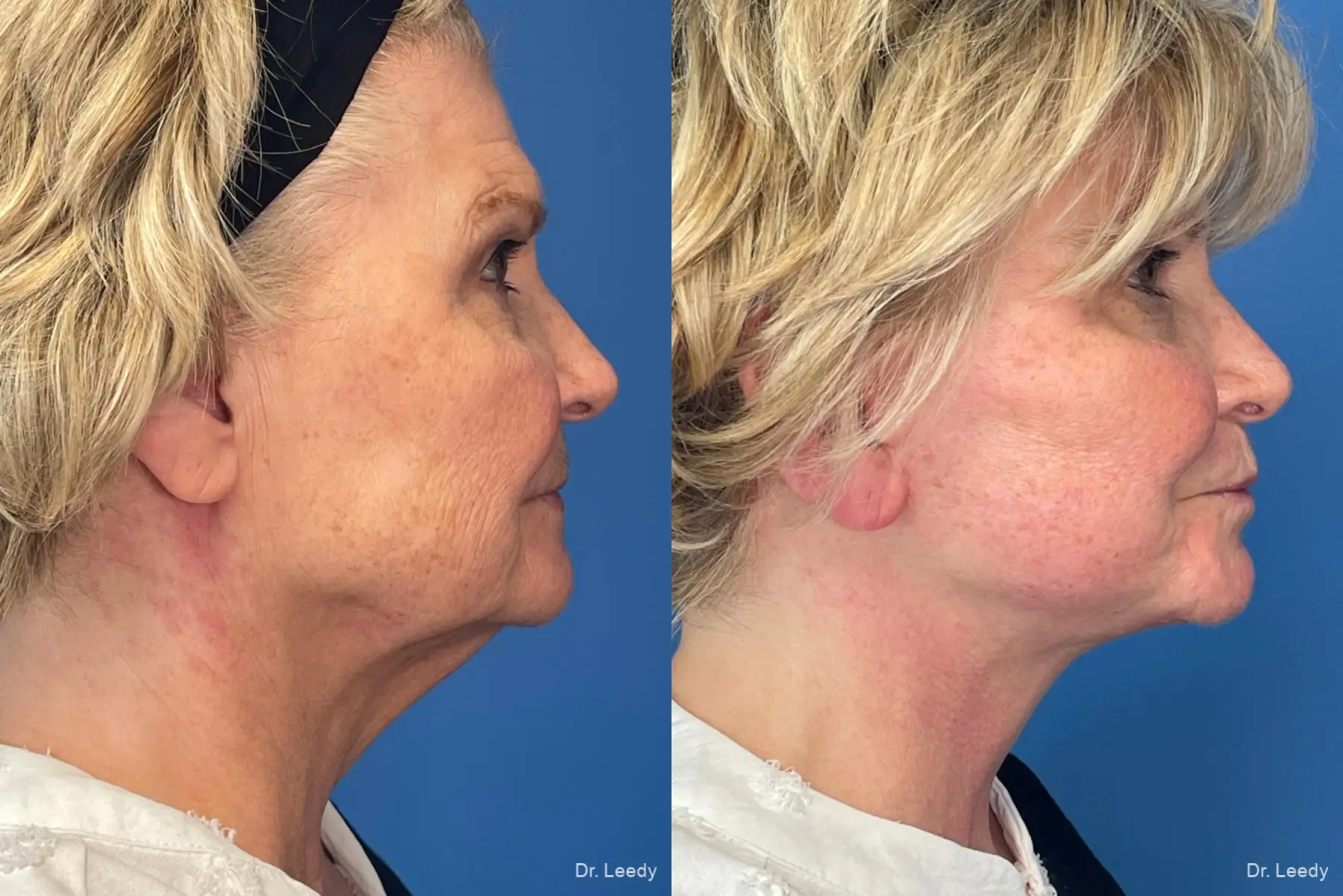 Facelift & Neck Lift: Patient 7 - Before and After  