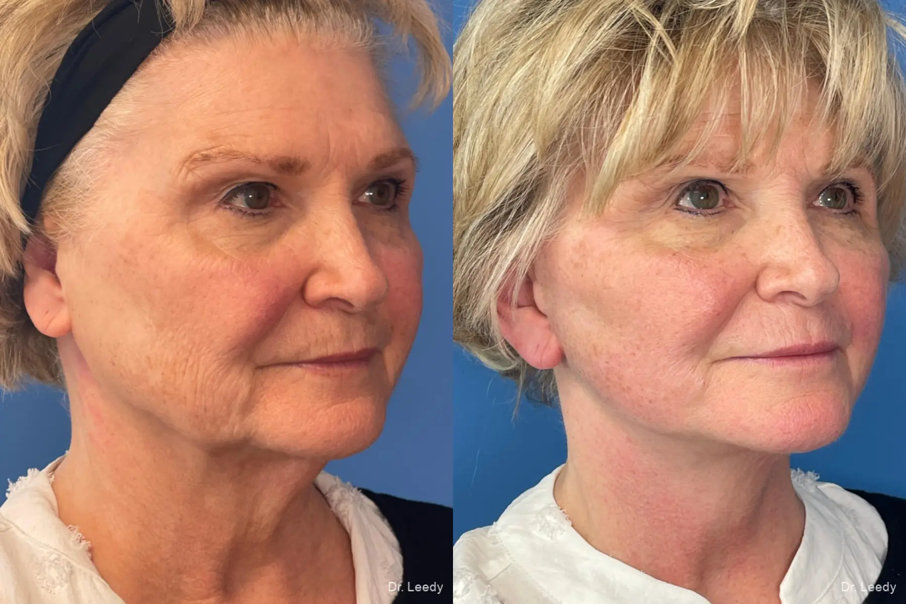 Facelift & Neck Lift: Patient 7 - Before and After 5