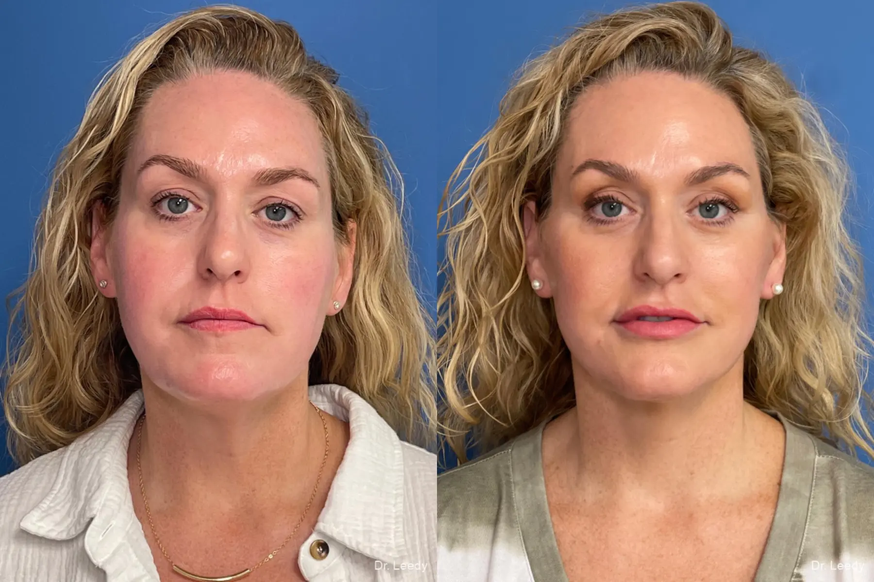 Facelift & Neck Lift: Patient 2 - Before and After  