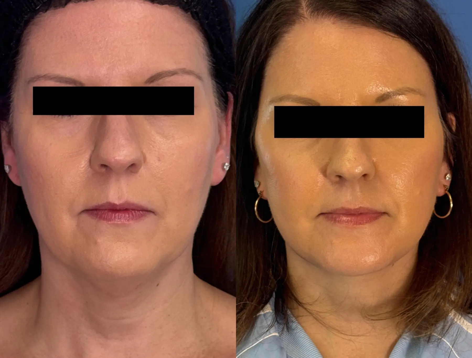 Facelift & Neck Lift: Patient 16 - Before and After  