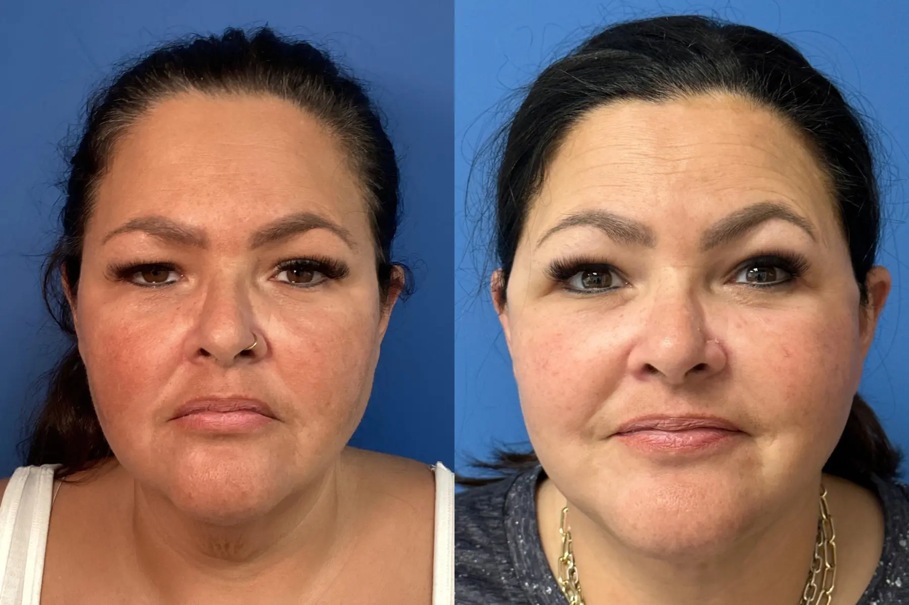 Facelift & Neck Lift: Patient 9 - Before and After  