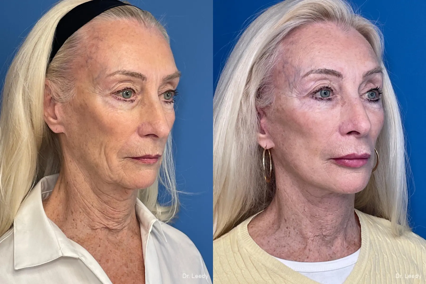 Facelift & Neck Lift: Patient 4 - Before and After 2