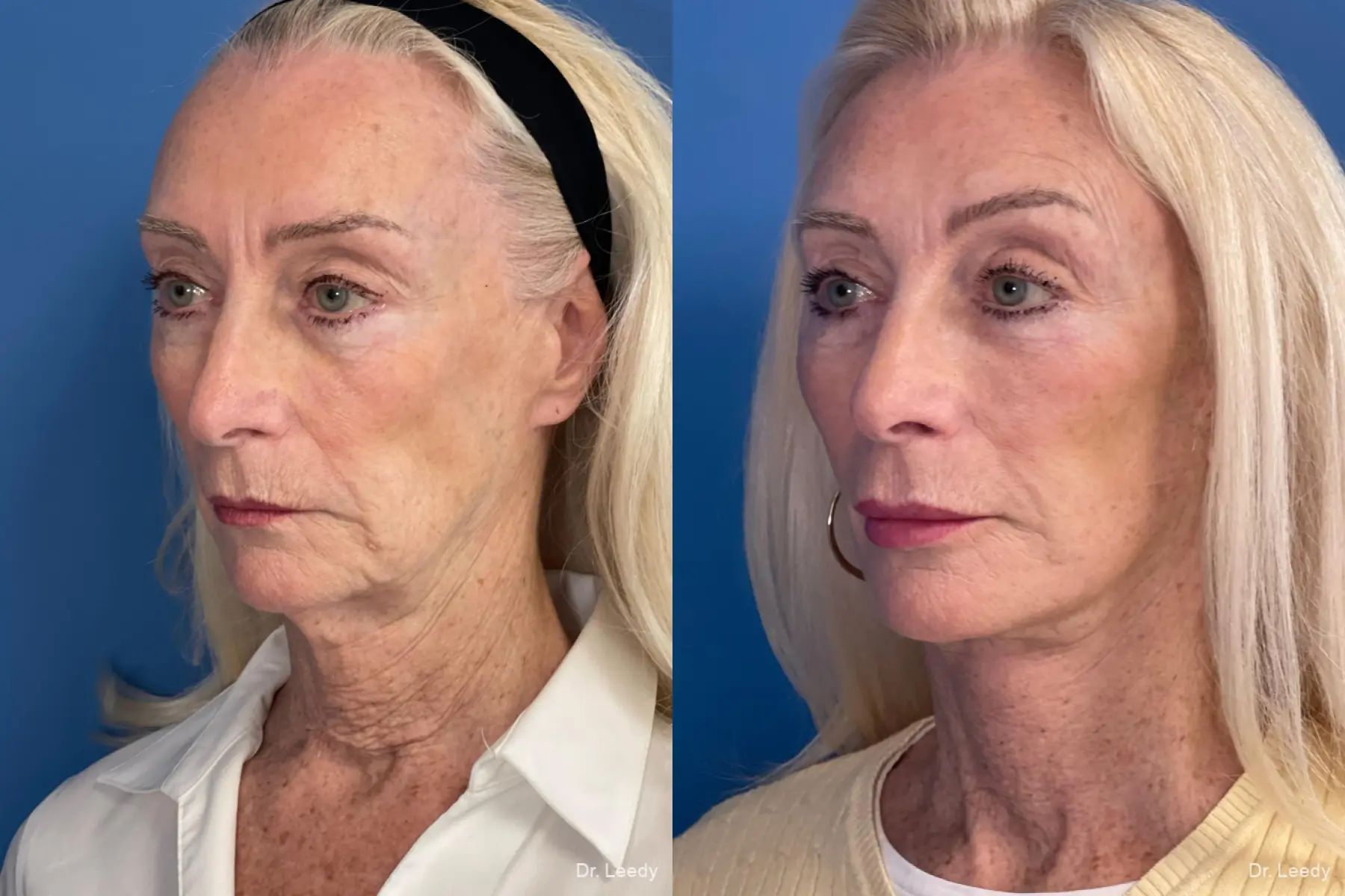 Facelift & Neck Lift: Patient 4 - Before and After 4