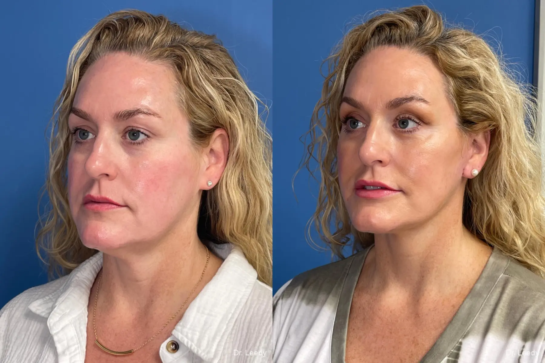 Facelift & Neck Lift: Patient 2 - Before and After 4
