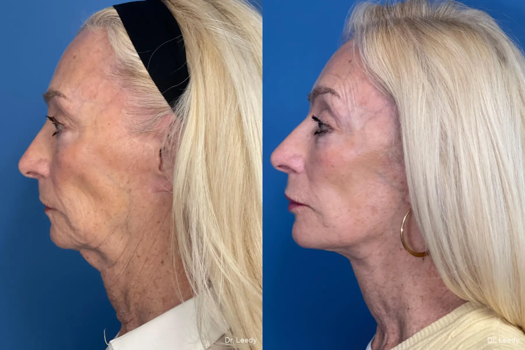 Facelift & Neck Lift: Patient 4 - Before and After 5