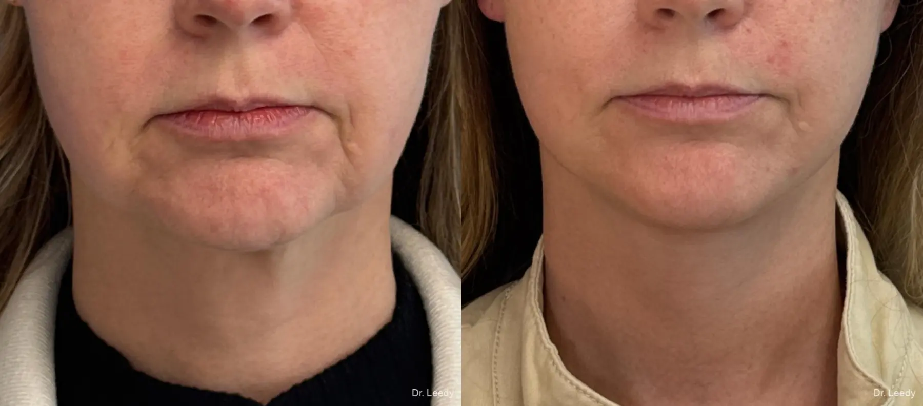 Facelift & Neck Lift: Patient 13 - Before and After  