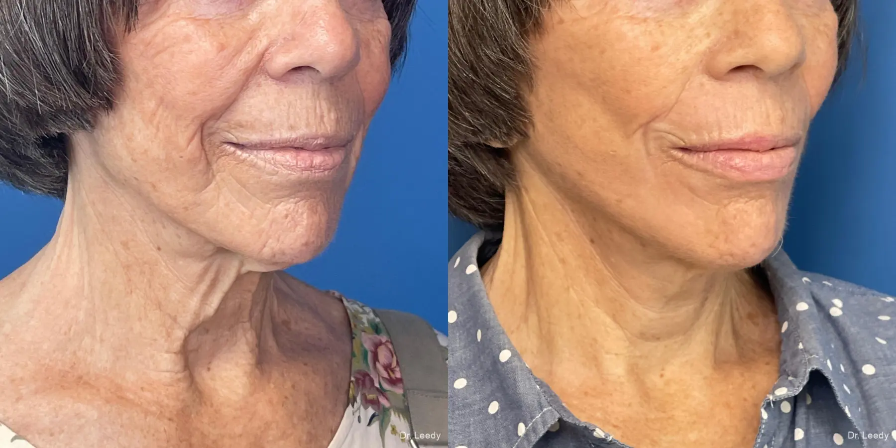 Facelift & Neck Lift: Patient 6 - Before and After 2