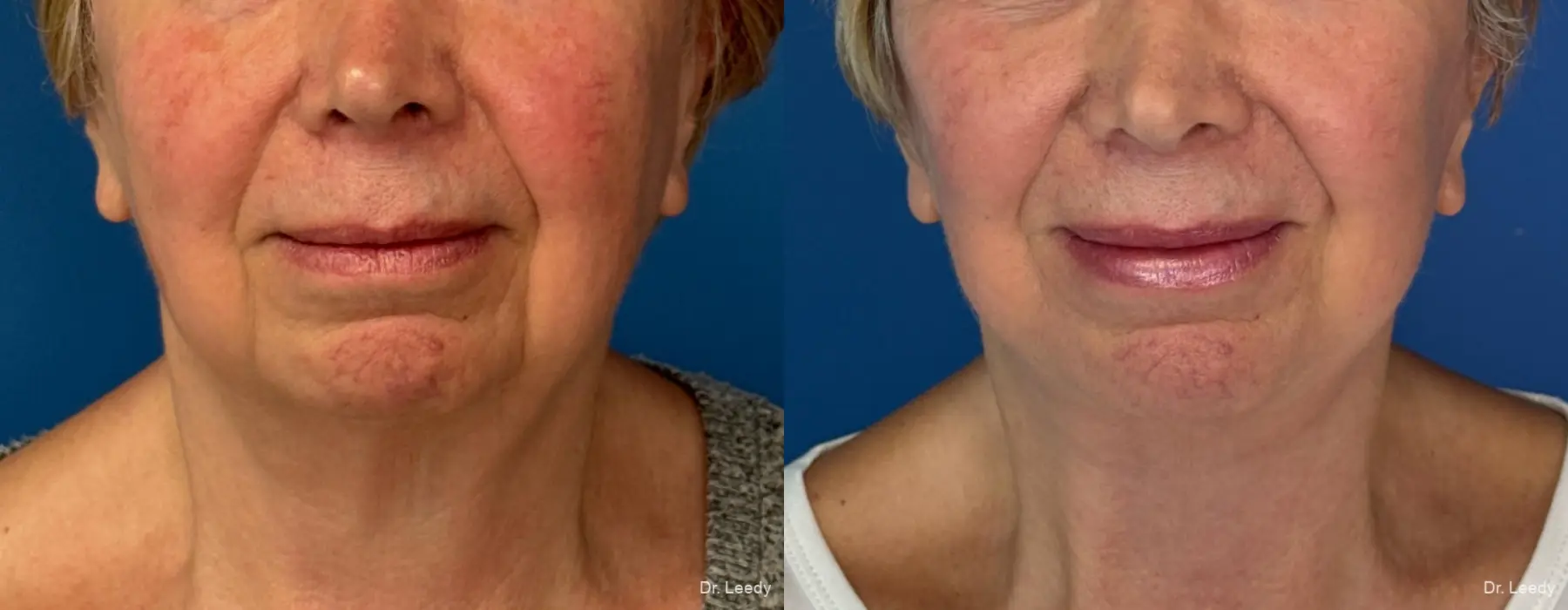 Facelift & Neck Lift: Patient 19 - Before and After  
