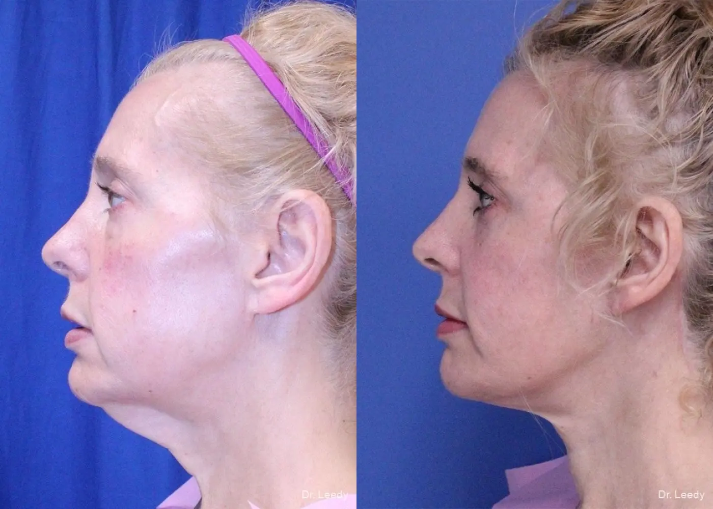 Facelift & Neck Lift: Patient 3 - Before and After 5