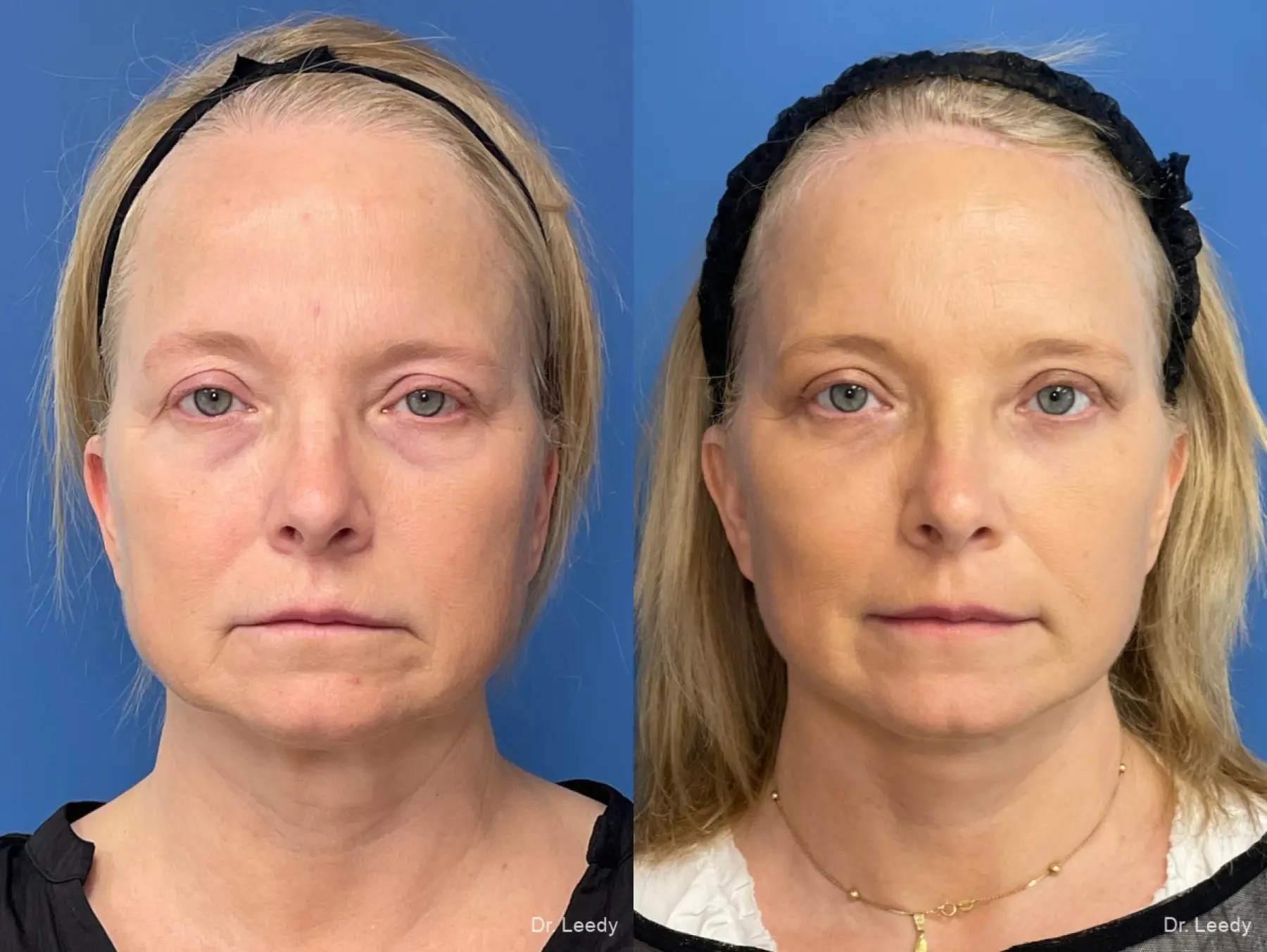 Facelift & Neck Lift: Patient 5 - Before and After 1