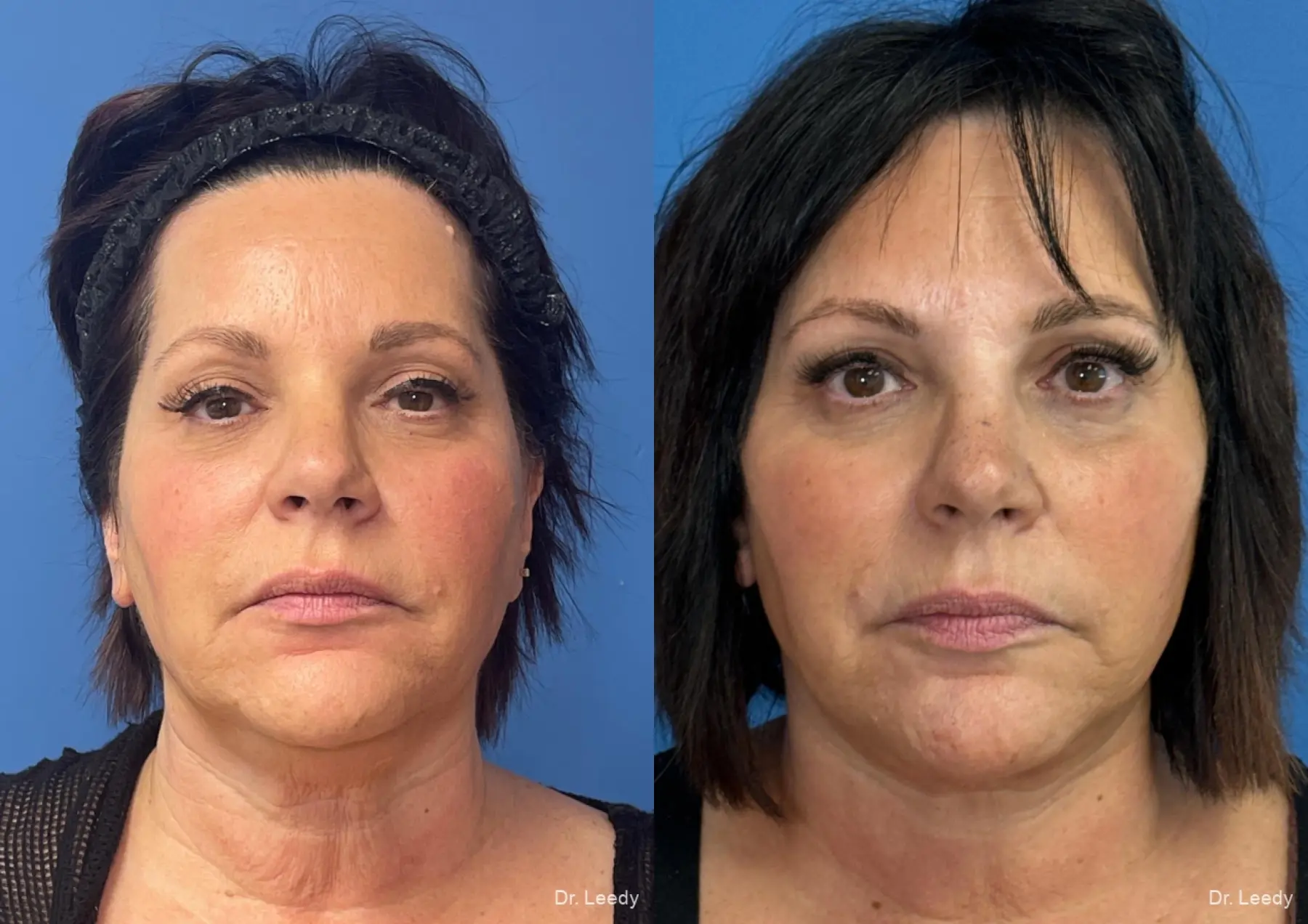 Facelift & Neck Lift: Patient 8 - Before and After  