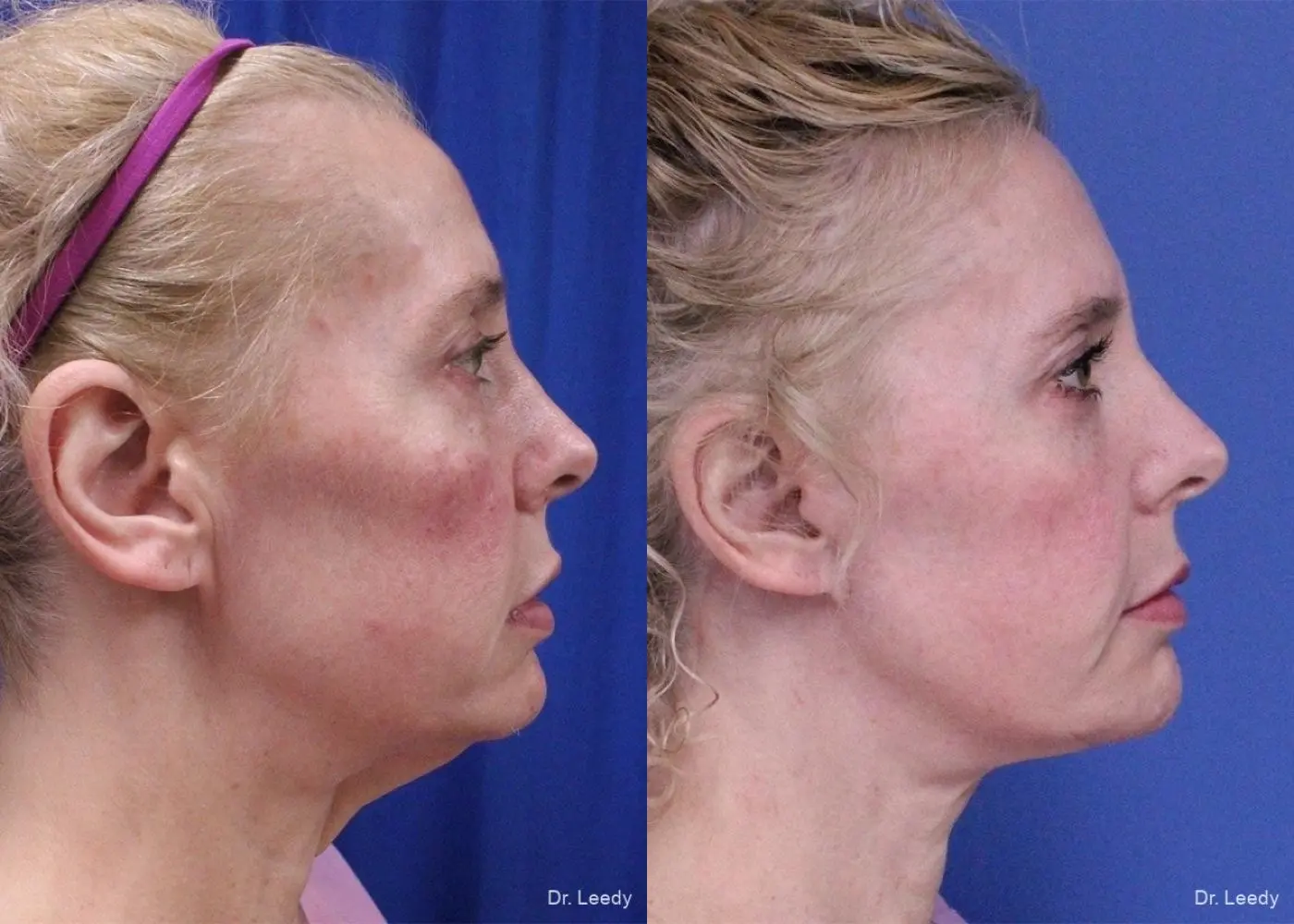 Facelift & Neck Lift: Patient 3 - Before and After 3