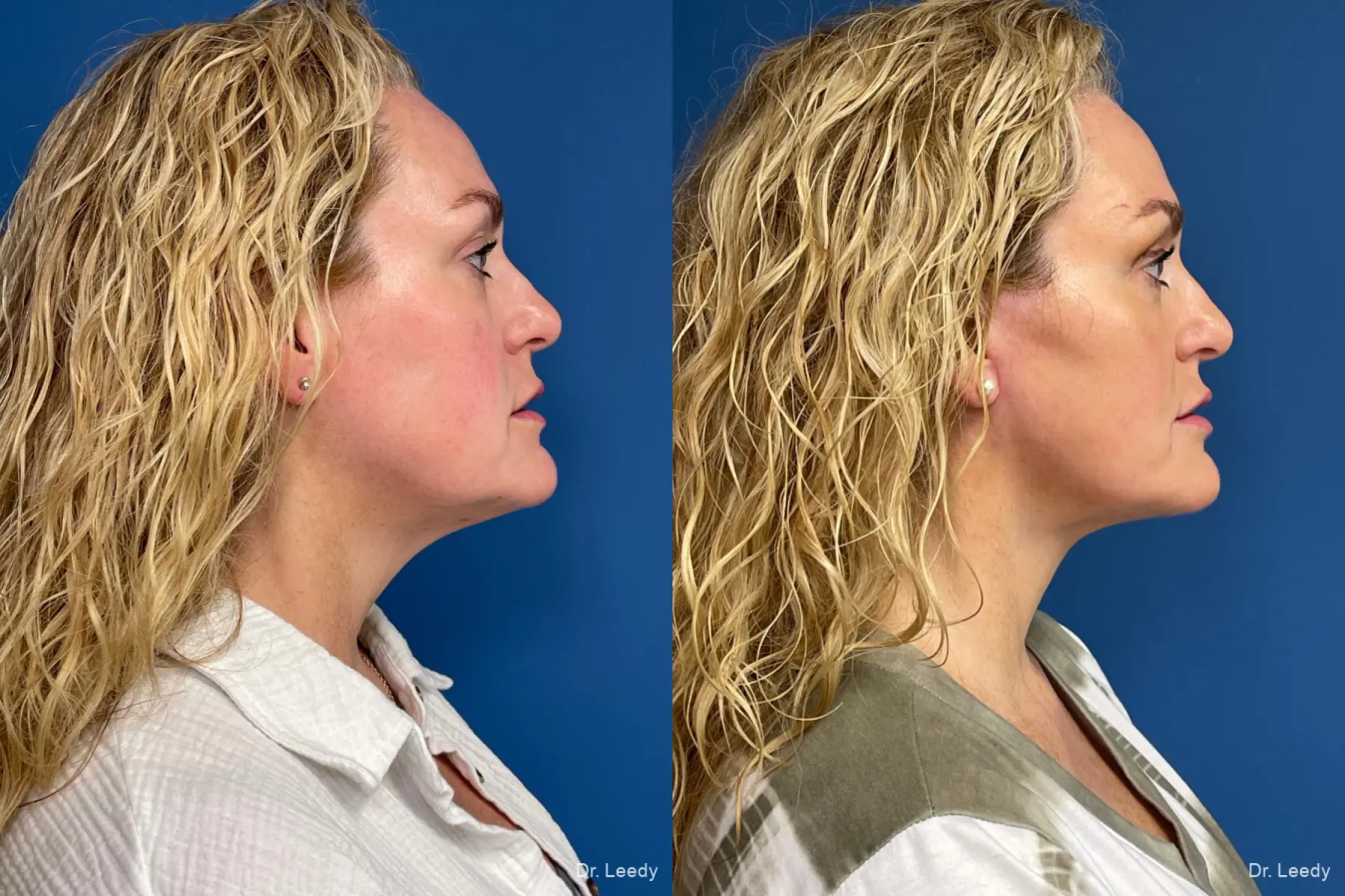 Facelift & Neck Lift: Patient 2 - Before and After 3