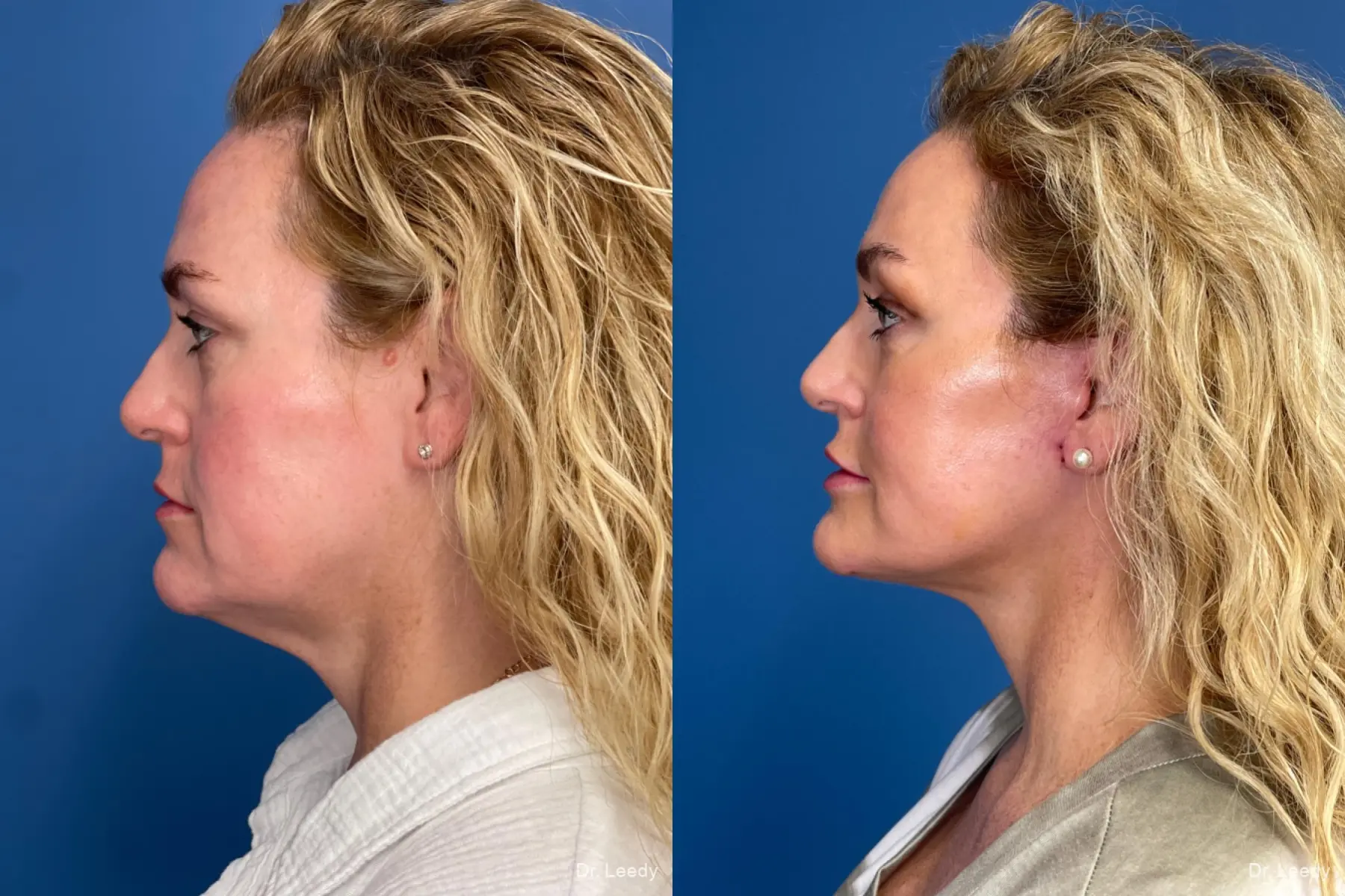 Facelift & Neck Lift: Patient 2 - Before and After 5