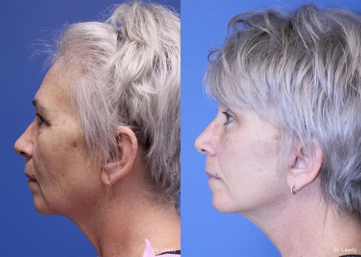 Facelift: Patient 4 - Before and After 5