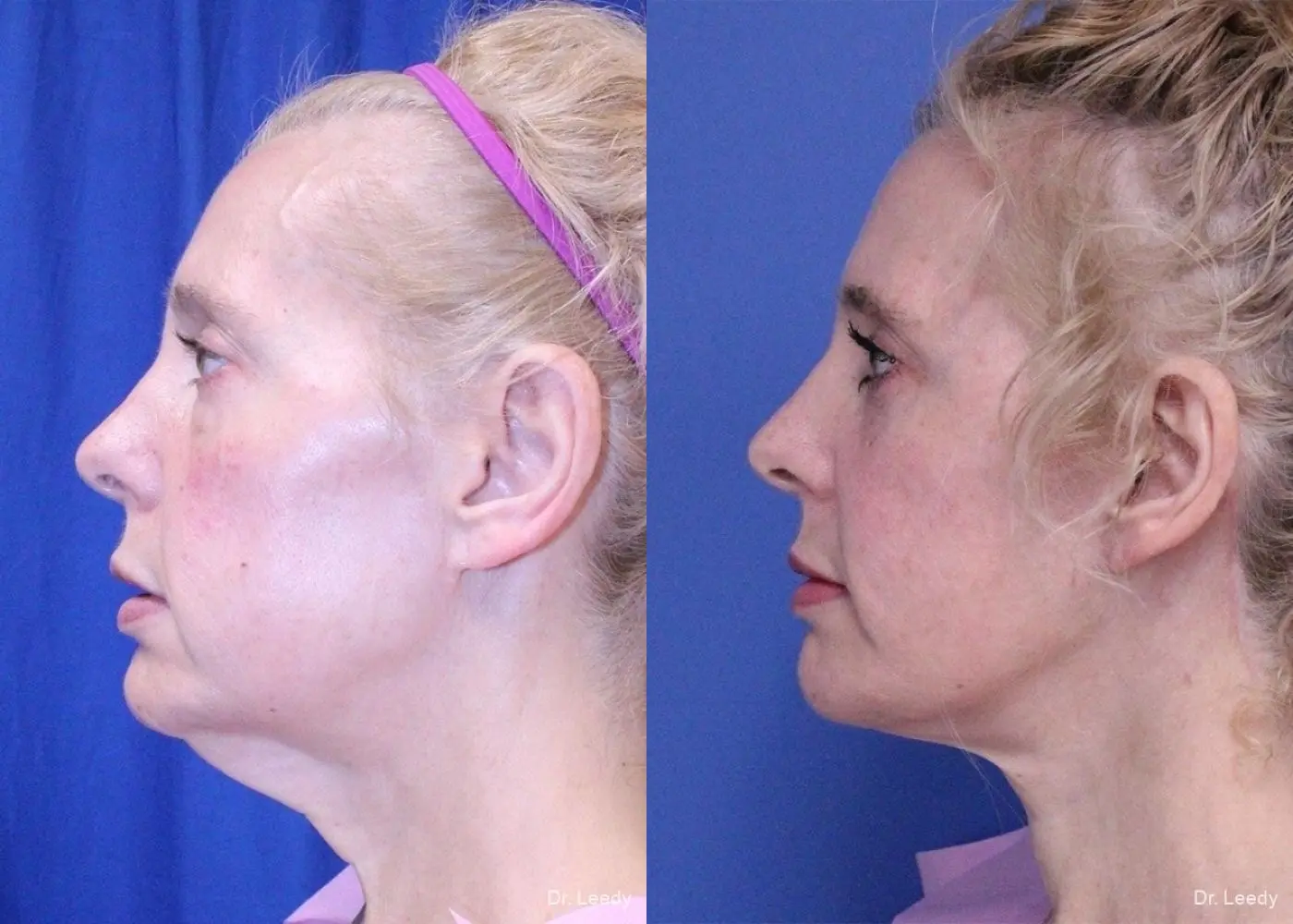 Facelift: Patient 2 - Before and After 5