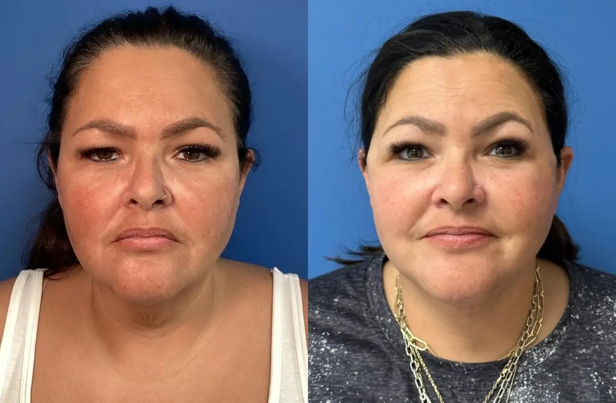 Facelift: Patient 2 - Before and After  
