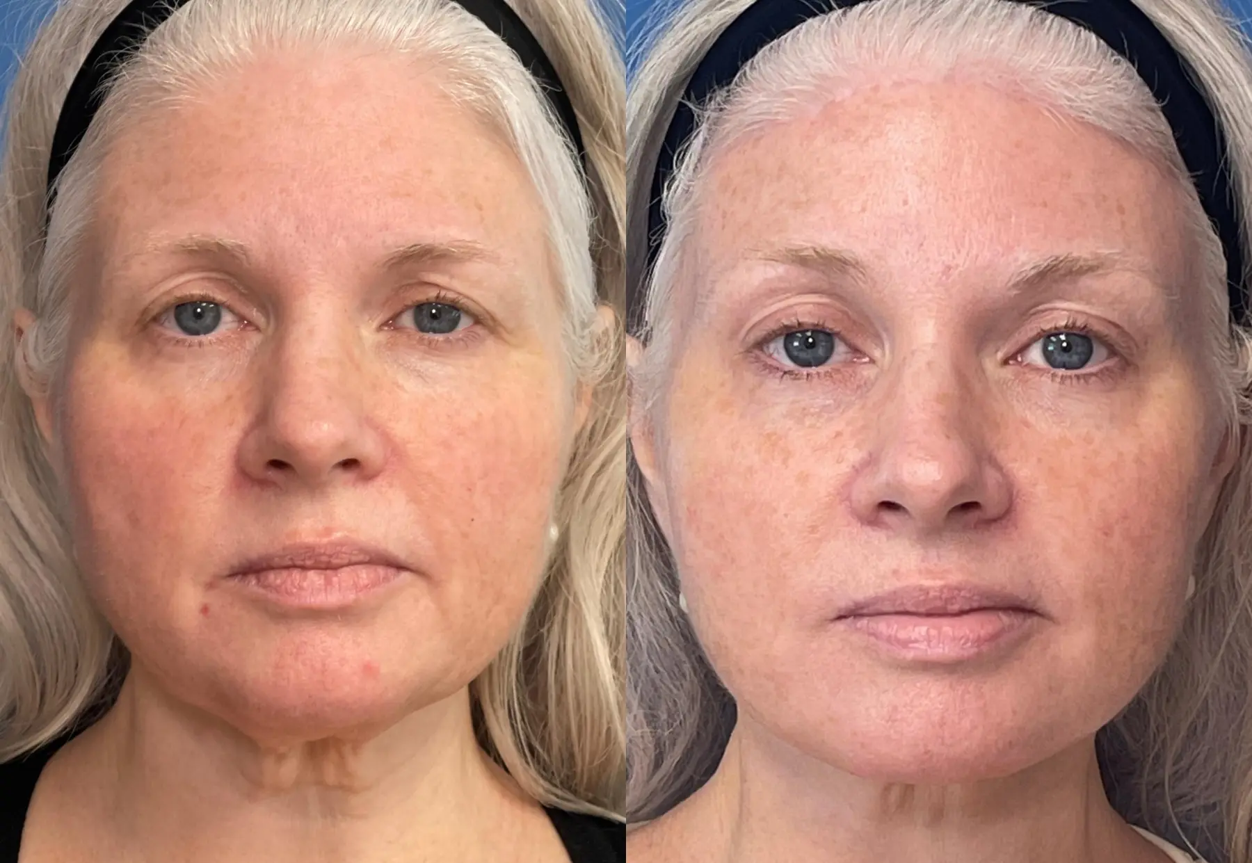 Facelift: Patient 6 - Before and After  