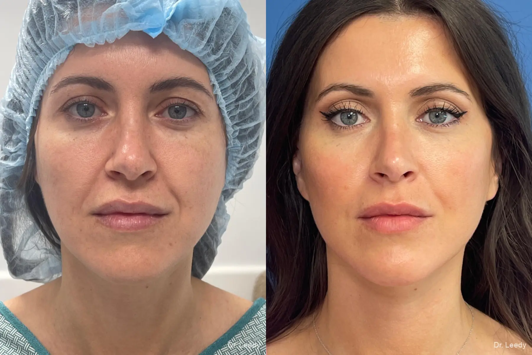 Facelift/Mini Facelift: Patient 2 - Before and After  