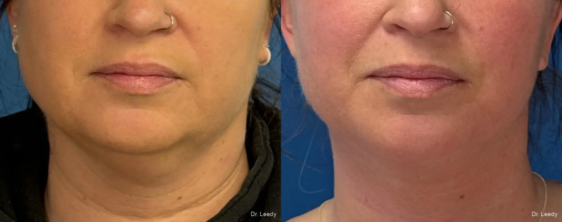 Facelift/Mini Facelift: Patient 3 - Before and After  