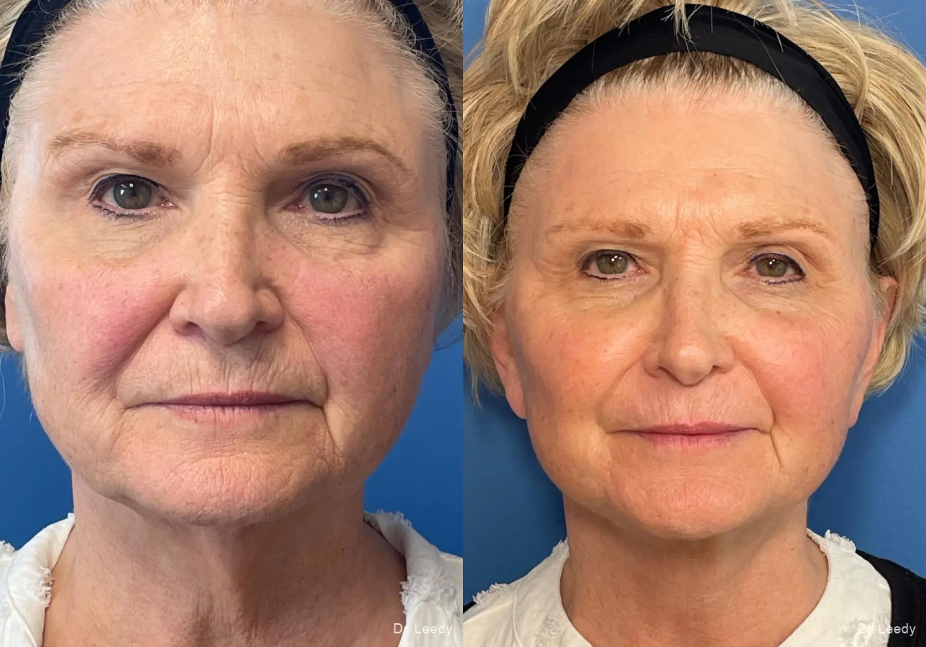 Facelift/Mini Facelift: Patient 1 - Before and After  