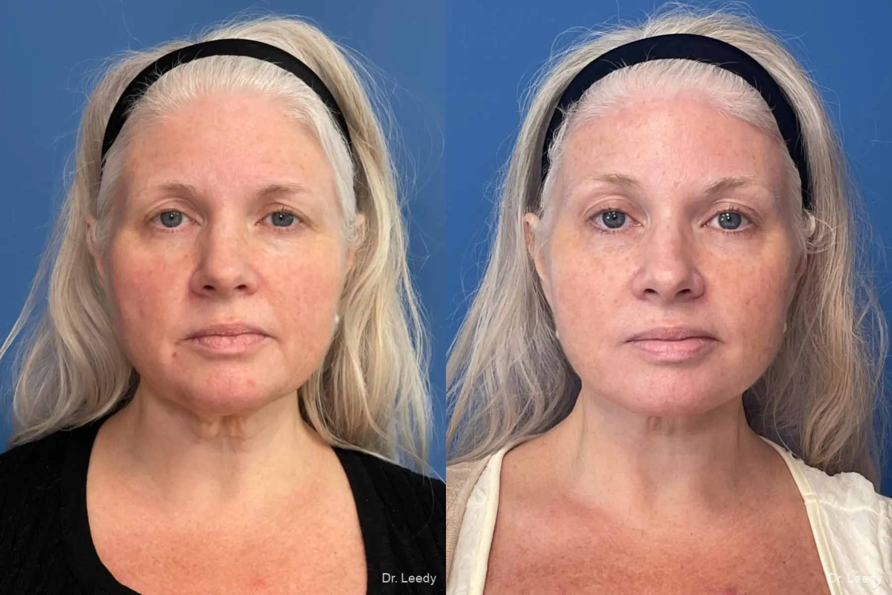 Facial Rejuvenation: Patient 1 - Before and After  