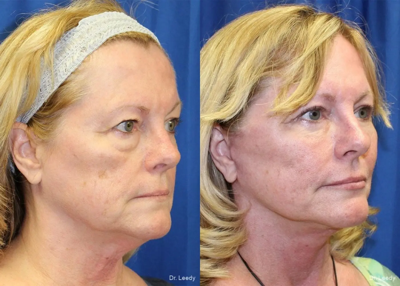Fat Grafting - Face: Patient 1 - Before and After 2