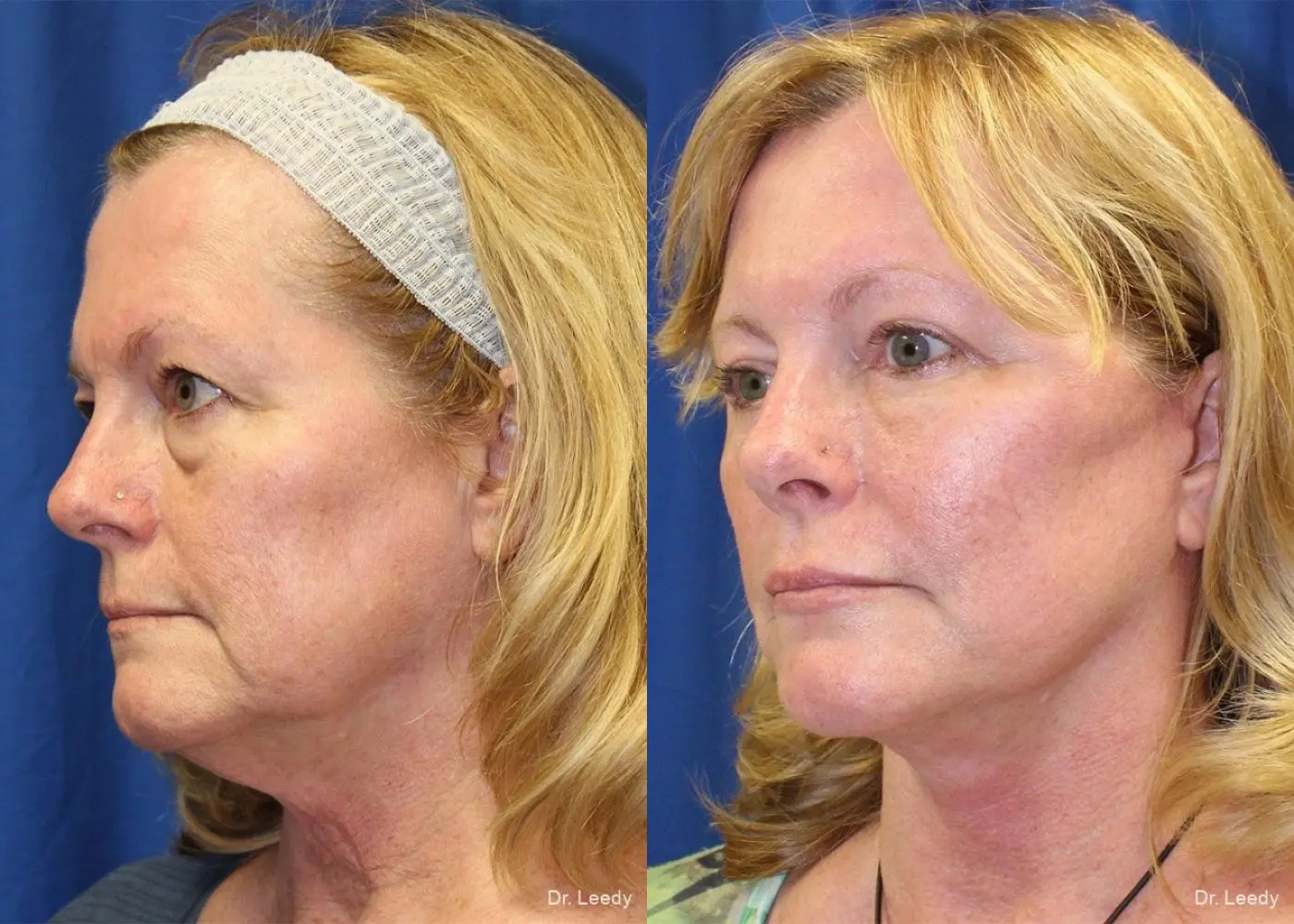 Fat Grafting - Face: Patient 1 - Before and After 4