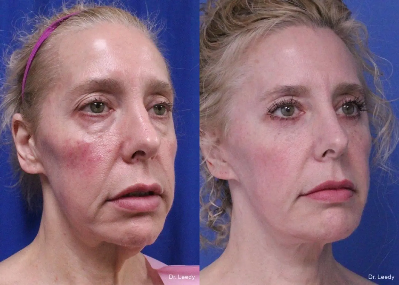 Fat Grafting - Face: Patient 2 - Before and After 2